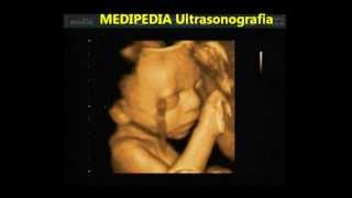 MEDIPEDIA Ultrassonografia Feto 7 meses 3D4D Real time [upl. by Anaer]