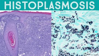 Histoplasmosis Two Extreme Examples Pseudotumor amp Zero Inflammation [upl. by Iaria869]