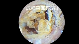 Cleaning of dry patches on the ear wall and eardrum｜ ASMR｜571 [upl. by Gilud865]