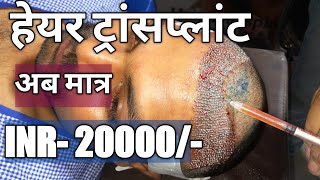 Best Hair Transplant Result at Lowest Cost In India  Latest Holi Offer  DrRajesh Sokhal [upl. by Nagah]