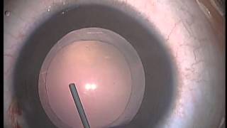 Pediatric Cataract Surgery Lens Aspiration PCCC Anterior Vitrectomy and IOL Implanation [upl. by Adla566]