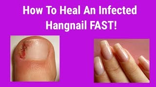 How To Heal An Infected Hangnail FAST [upl. by Nellir]