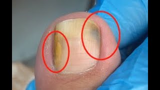 Toenail turns into black and yellow due to fungus [upl. by Adaran]