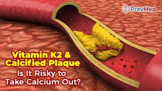 Vitamin K2 amp Calcified Plaque  Is It Risky to Take Calcium Out [upl. by Redneval]