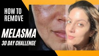 Melasma Removal at Home I Melasma Remove cream I Melasma Skin Care Regimen Routine [upl. by Enneira]