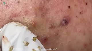 Big Cystic Acne Blackheads Extraction Blackheads amp Milia Whiteheads Removal Pimple Popping [upl. by Ettelracs962]