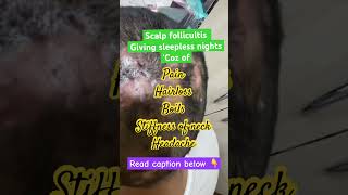 Scalp follicultis dermatologist in Punjab boils scalp infection parisaskinclinic drashimagoel [upl. by Floyd]