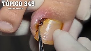 UNHA INFLAMADA E ENCRAVADA INFLAMED AND INGROWN NAIL  PODÓLOGO MAURÉLIO [upl. by Yraht]