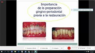 Clase Operatoria 22 04 Periodoncia en relación con la Operatoria Dental [upl. by Now54]