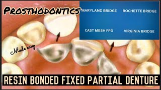 RESIN BONDED FIXED PARTIAL DENTURE II ROCHETTE MARYLAND CAST MESH VIRGINIA BRIDGES II FPD II easy [upl. by Lezned]