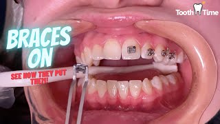 How do they put braces on  Tooth Time Family Dentistry New Braunfels [upl. by Rodie]