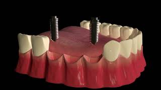 Dental Bridge Procedure [upl. by Aphrodite]