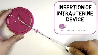 Insertion of Intrauterine Device [upl. by Nnylyt]