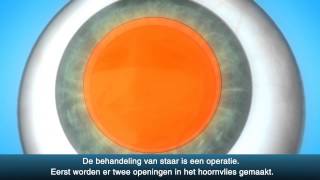 Staaroperatie cataract  OLVG Oogheelkunde [upl. by Ahsaf]