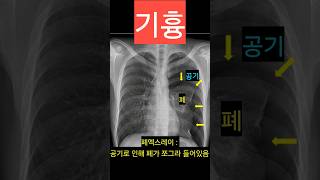 기흉 엑스레이 CT 진단 pneumothorax lung air [upl. by Lindeberg]