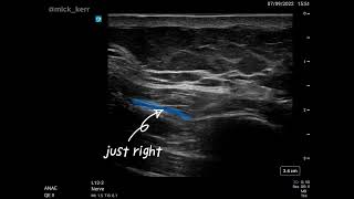 External oblique intercostal plane block [upl. by Aneleairam844]