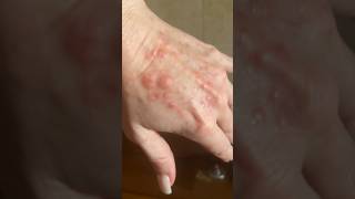 Sun Poisoning or Polymorphous Light Eruption Skin Rash [upl. by Emmye]