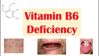 Vitamin B6 Pyridoxine Deficiency  Dietary Sources Causes Signs amp Symptoms Diagnosis Treatment [upl. by Ahsienal664]