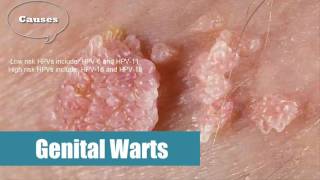  Genital Warts HPV  Human Papilloma Virus Causes [upl. by Aicrop]