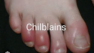 chilblains urdu  Dr Jamil Anwar [upl. by Epilef]