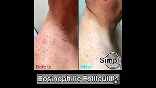 Eosinophilic Folliculitis [upl. by Ffoeg]