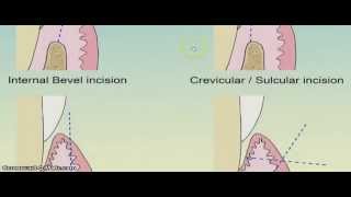 How to put internal bevel incision [upl. by Mich]