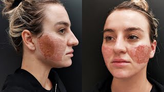 Acne Scar Removal with CO2 Laser Treatment  Before amp After [upl. by Hareenum]