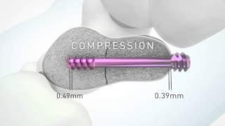 HBS 2 Headless bone screw by KLS Martin [upl. by Fax]