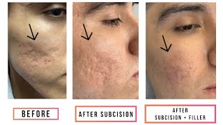 Subcision  Filler for Acne Scars [upl. by Ahsieyn107]