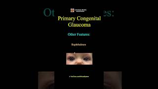 Primary Congenital Glaucoma Triad [upl. by Sirdna43]