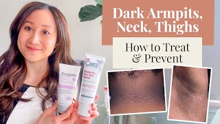 Treating and Preventing Dark Armpits Thighs Neck and Arms  Dr Jenny Liu [upl. by Ajay304]