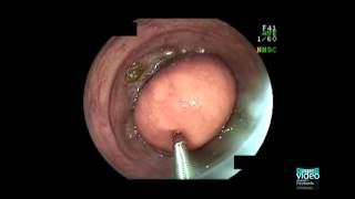 Colonic lipoma [upl. by O'Rourke]