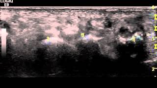 Ultrasound of a Mortons Neuroma and Mulders click test  Dr Peter Resteghini [upl. by Bilow576]