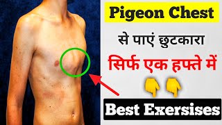 Pectus carinatum Exersises in hindi  Pigeon chest ko kaise thik kare  pigeon chest Exercise [upl. by Dworman]