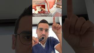 GREFFE dentaire  le clé du sinus lift avec implant [upl. by Rodge401]