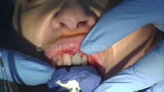 Extraction implantation immédiate dune incisive centrale [upl. by Benedikta910]