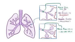 Respiratory Syncytial Virus and Bronchiolitis causes symptoms diagnosis treatment pathology [upl. by Dahraf437]