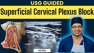 USG GUIDED SUPERFICIAL CERVICAL PLEXUS BLOCK  Cervical plexus anatomy  Real USG video of BLOCK [upl. by Haroppizt]