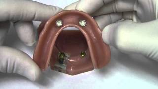 Implant Overdenture  Model Demonstration [upl. by Jary632]