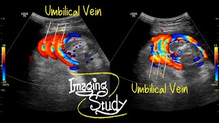 Three Layers of Umbilical Cord around the Fetal Neck  Ultrasound  Doppler  Case 36 [upl. by Vergos800]