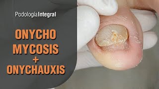 Onychomycosis  Onychauxis podology asmr [upl. by Zelle]