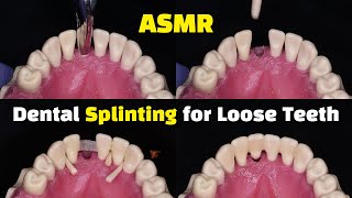 Dental Splinting for Loose Teeth using Ribbond after a Tooth Extraction [upl. by Mcclain]