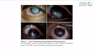 Corneal Hydrops Rethinking Treatment [upl. by Elodia]