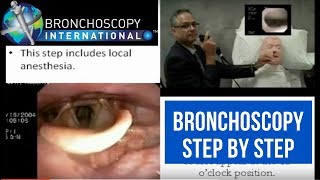 Bronchoscopy Step by Step Walkthrough 16 [upl. by Edie]