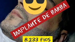 IMPLANTE DE BARBA NATURAL 8322 FIOS [upl. by Sanchez]