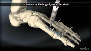 1st Metatarsal Phalangeal Joint Arthrodesis [upl. by Odlanyer]