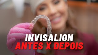 Invisalign  Casos antes e depois [upl. by Ardnahsal951]