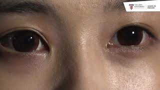 Examination of the Pupil and Pupillary responses Dr Prabal Bhargava [upl. by Naillig]