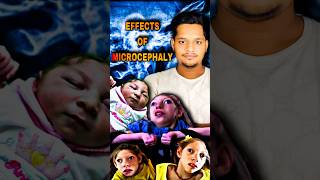 What is Microcephaly  Effects of Microcephaly  microcephaly india shorts facts ytshortsindia [upl. by Yelrah267]