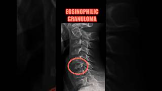 Eosinophilic Granuloma bones radiology doctor [upl. by Vernita574]